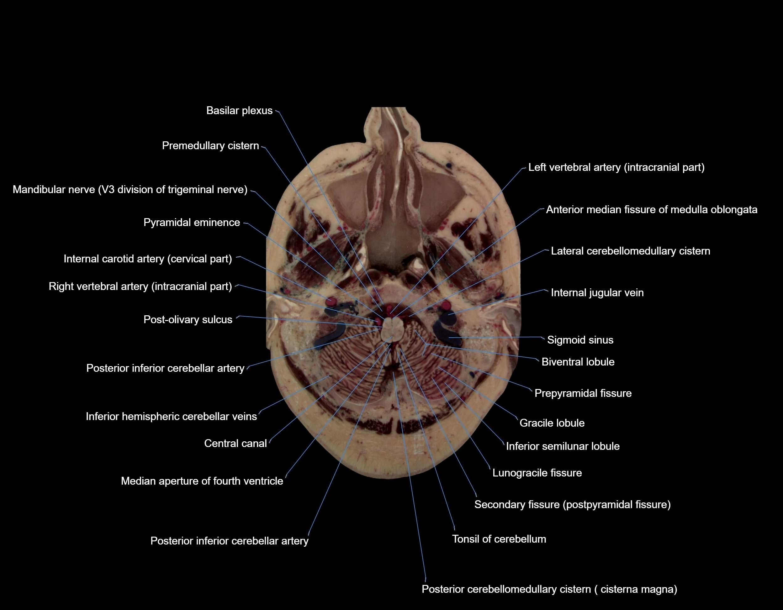 MRI Brain axial cross sectional radiology anatomy 3T image  -img-00006.webp